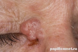 Фото базалиомы на лице