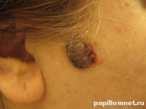 Фото базалиомы, которую нужно удалить