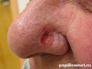 Фото базалиомы на носу