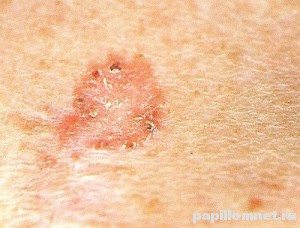 Изображение базалиомы начальной стадии