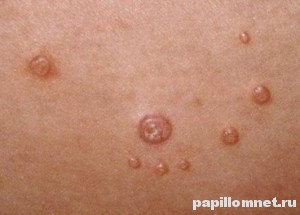 Изображение бородавок на теле человека