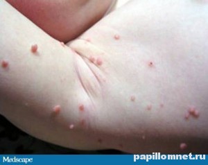 Фото бородавок в подмышечной зоне