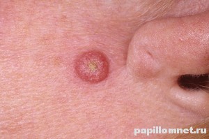 Фото кератоакантомы на коже лица