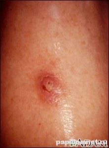 Фото кератоакантомы