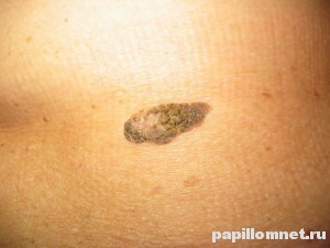 Фото кератомы