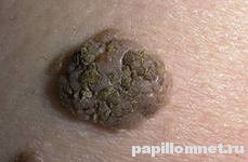 Фото себорейной кератомы Фото себорейной кератомы