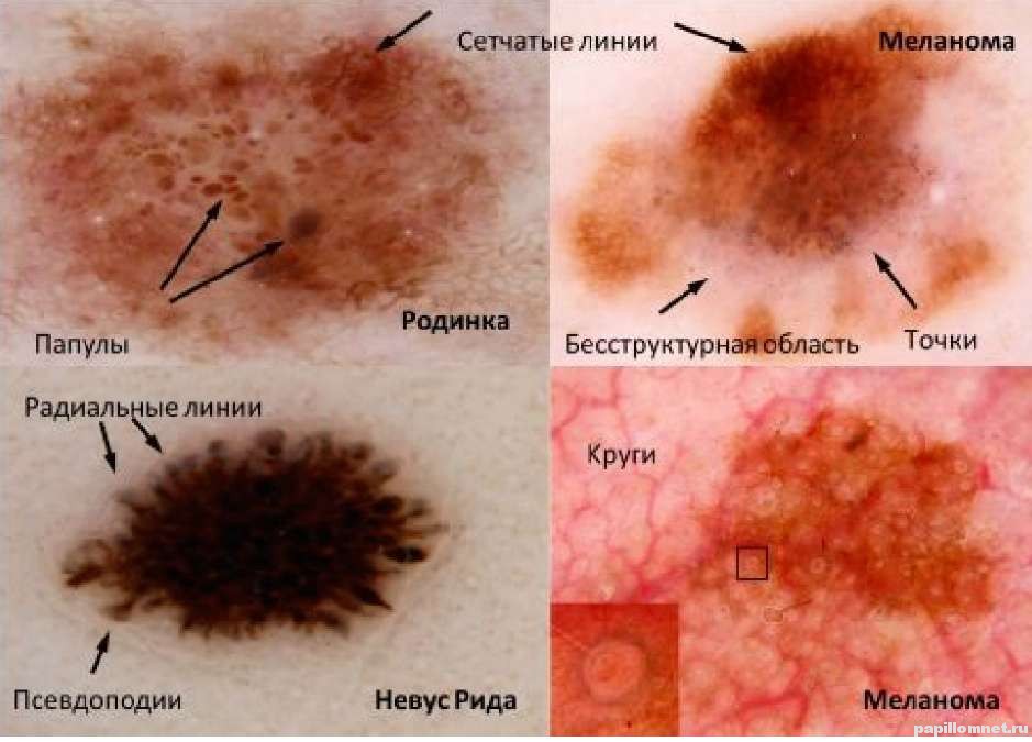 Признаки развития меланомы Признаки развития меланомы