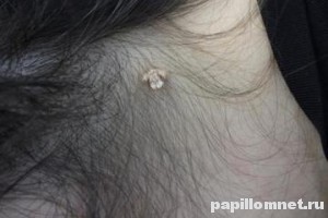 Фото бородавки в волосяной части головы