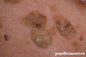 Изображение себорейного кератоза на коже