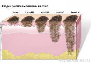 Фото стадий меланомы