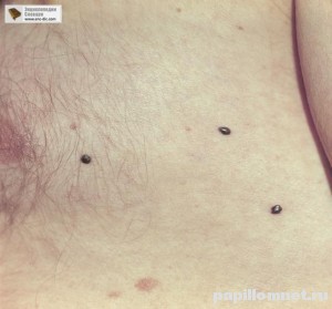 Метастазирование внутрикожной меланомы