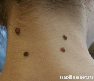 Фото родимых пятен на теле