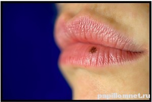 Фото родинки на губе