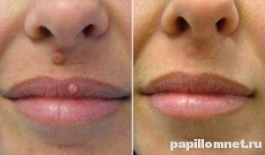 До и после удалния родинки на лице