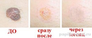Фото изменения родинки после операции