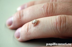 Фото бородавки на пальце руки
