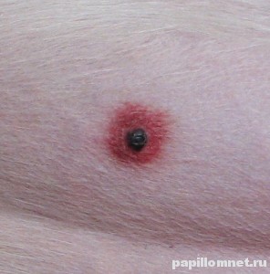 Фото родинки на теле человека которую содрали