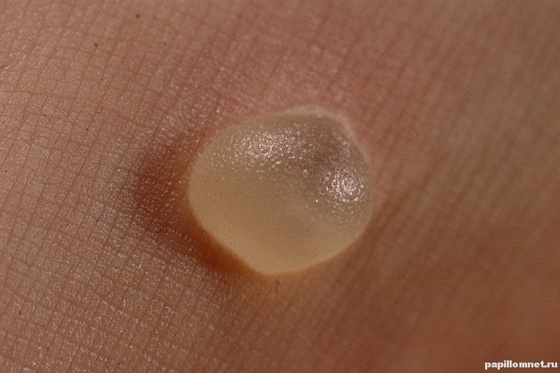 Фото мозоли