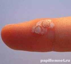 Фотография бородавки после воздействия жидким азотом