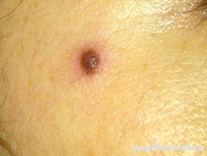 Родинка которая начала чесаться