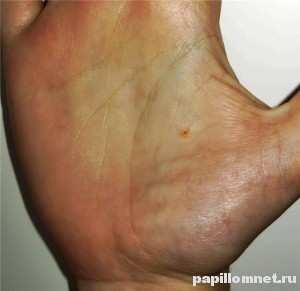 Фото родинки на правой ладони