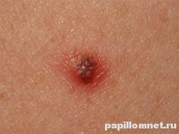 Напухшая родинка