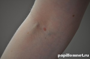 Фото родинок на руках