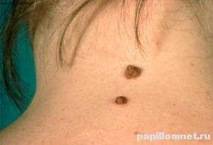 Фото родинок на шее, которые появились у беременной женщины
