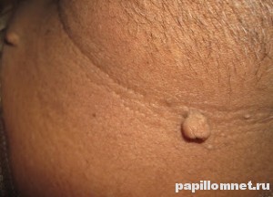 Изображение висячей родинки на шее человека