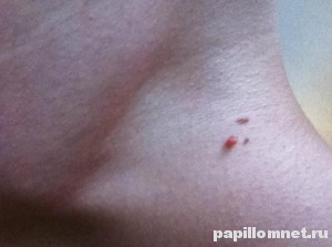 Фото висячей родинки на шее человека