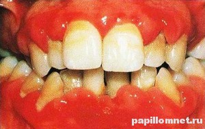 Фото гингивита у человека