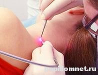 Фото удаления папилломы лазером