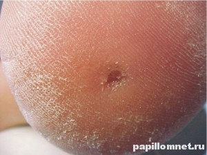 Подошвенная бородавка