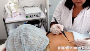 Фото электрокоагуляции папилломы на спине