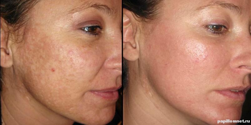 Пигментация лица до и после беременности