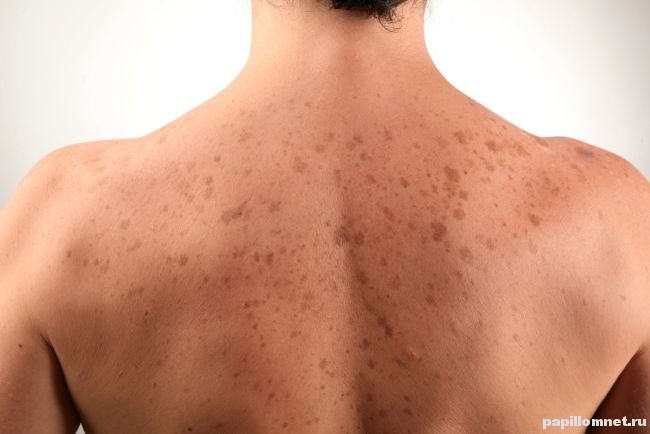 Появление пигментных пятен на спине человека