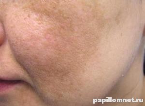 Небольшие пигментные пятна на коже лица человека