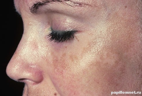 Пигментные пятна на левой щеке женщины