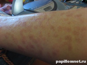 Фото появления пигментных пятен на левой ноге человека