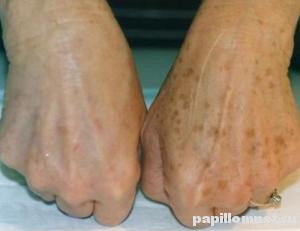 Пигментные пятна на руках - до и после отбеливания