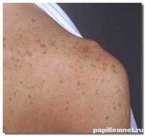 Пигментные пятна на правом плече человека