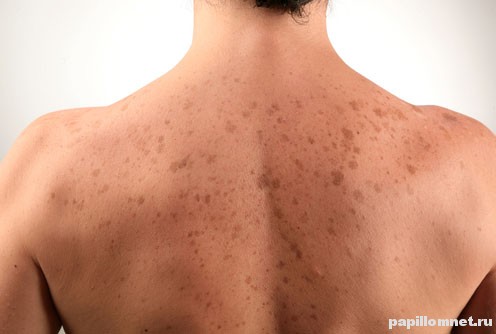 Фото пигментных пятен на теле человека