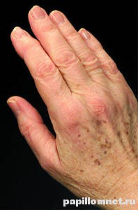 Фото пигментных пятен на руке