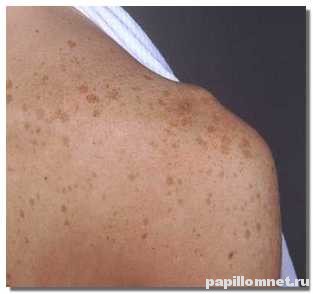 Плечо человека, на котором появились пигментные пятна