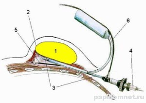 Схема удаления новообразования, номер 1 - это липома, номера 3, 4, 5 и 6 - хирургический прибор