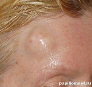 Липома на лбу Фото образования липомы на лбу женщины