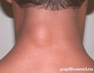 Доброкачественная липома на шее мужчины