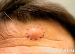 Обозначение контура липомы перед процедурой удаления