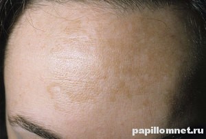 Пигментация кожи на лбу девушки