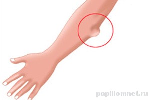 Схематичное проявление липомы на руке Схематичное изображение проявления липомы на руке